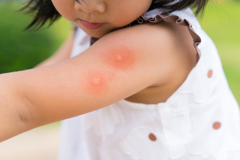 kid with mosquito bites
