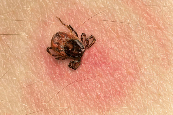 tick biting human