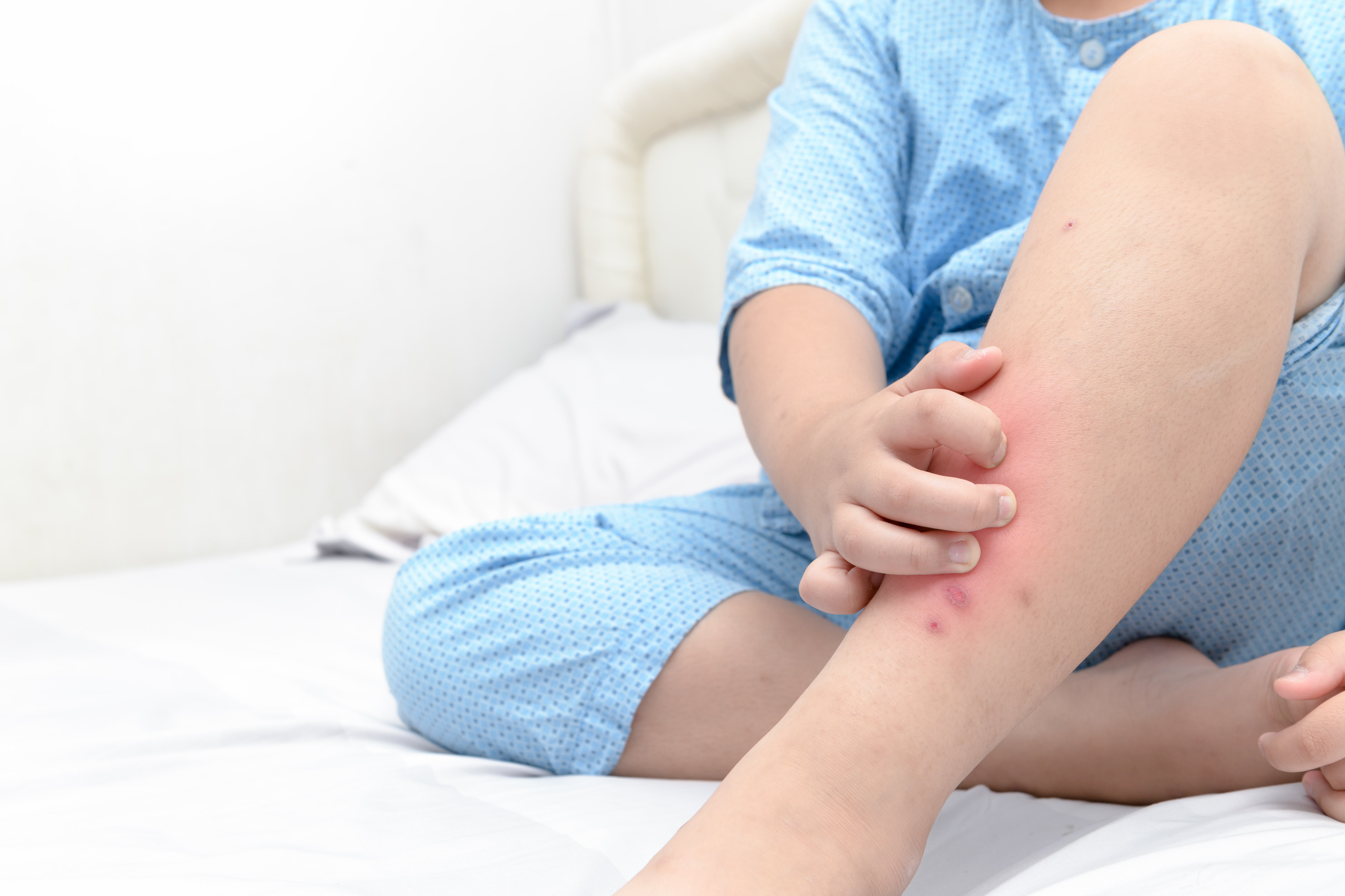 bed bug bites on toddler