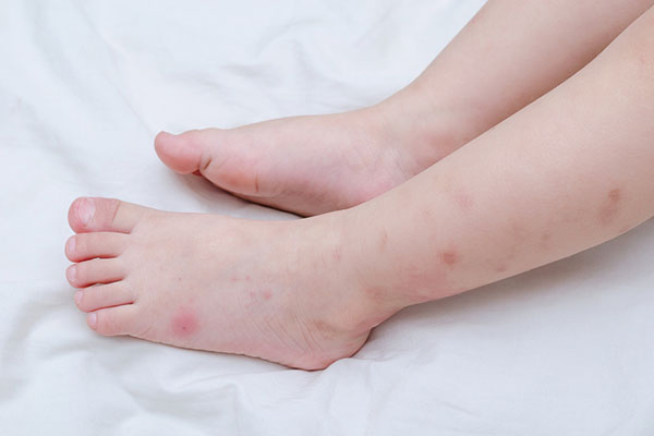 bed-bug-bites