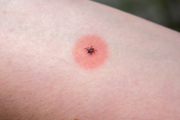 Tick on skin