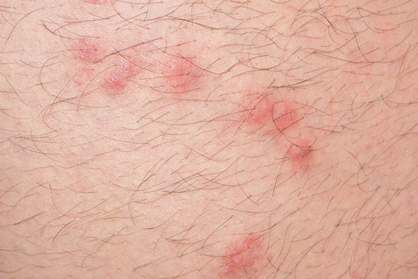 flea-bites