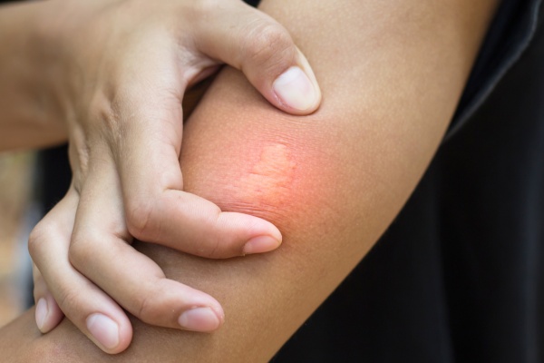 bee sting on a body