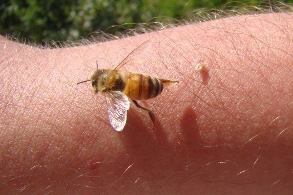 bee stinging a human