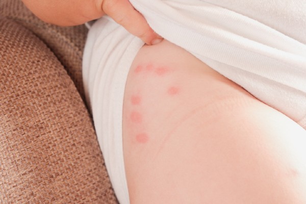 bed bugs on a toddler